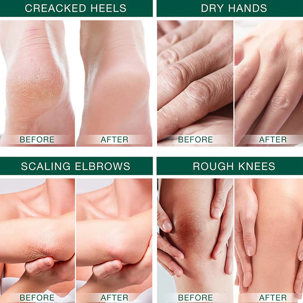 Urea Cream 42%, Foot Cream for Dry Cracked Heels, Urea Cream 42 Percent for Feet, Moisturizing & Exfoliating Foot Cream with 2%